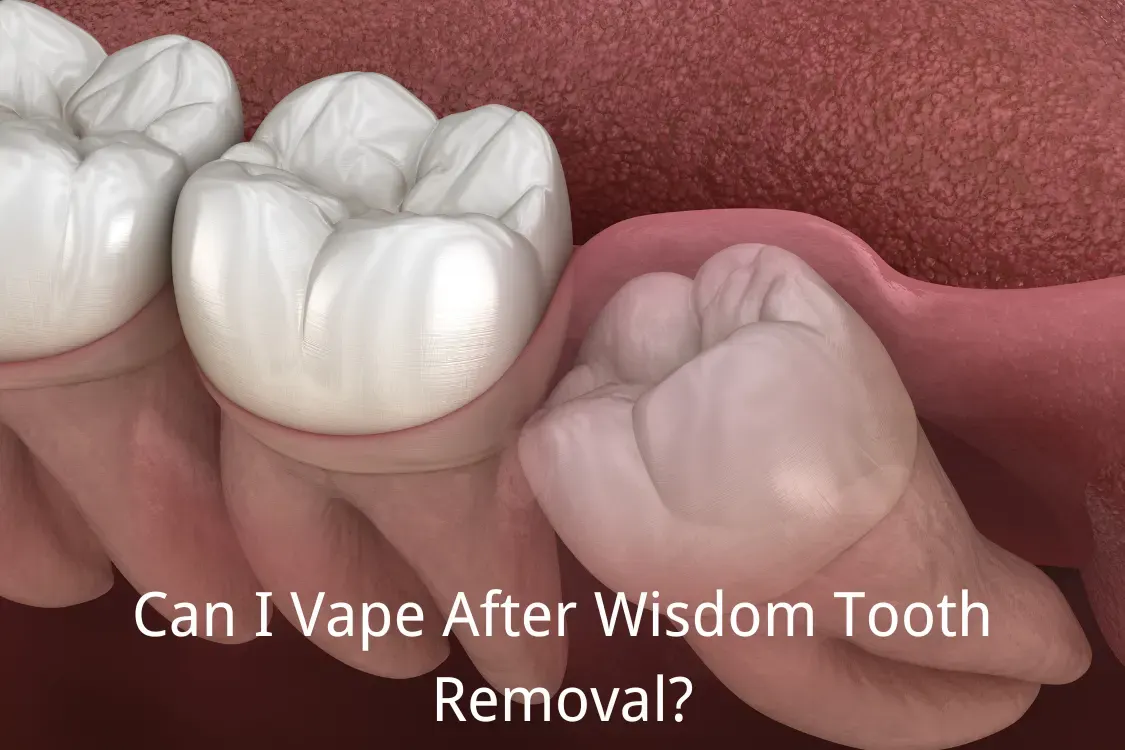 Can I Vape After Wisdom Tooth Removal?